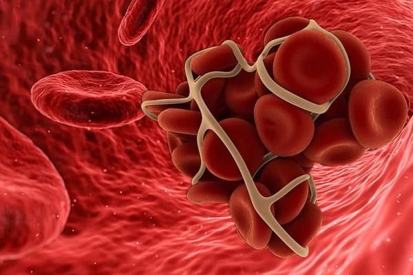 SAĞLIK Obezite ve sigara kullanımı tromboz riskini artırıyor SAĞLIK Obezite ve sigara kullanımı tromboz riskini artırıyor